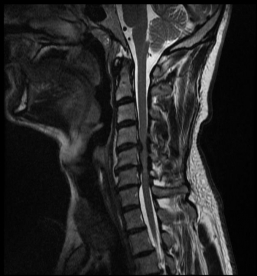 Spinalkanalstenose II